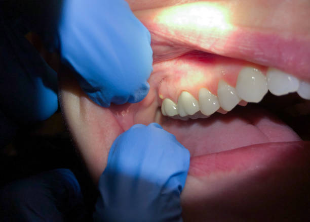 Best Urgent Care for Lost Fillings or Crowns in Bourbon, IN