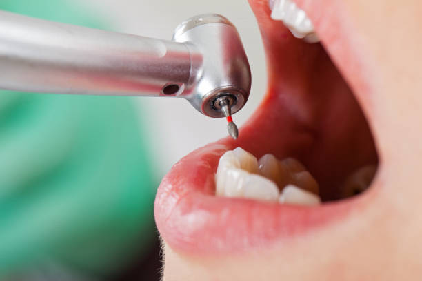 Best Emergency Tooth Extraction in Bourbon, IN